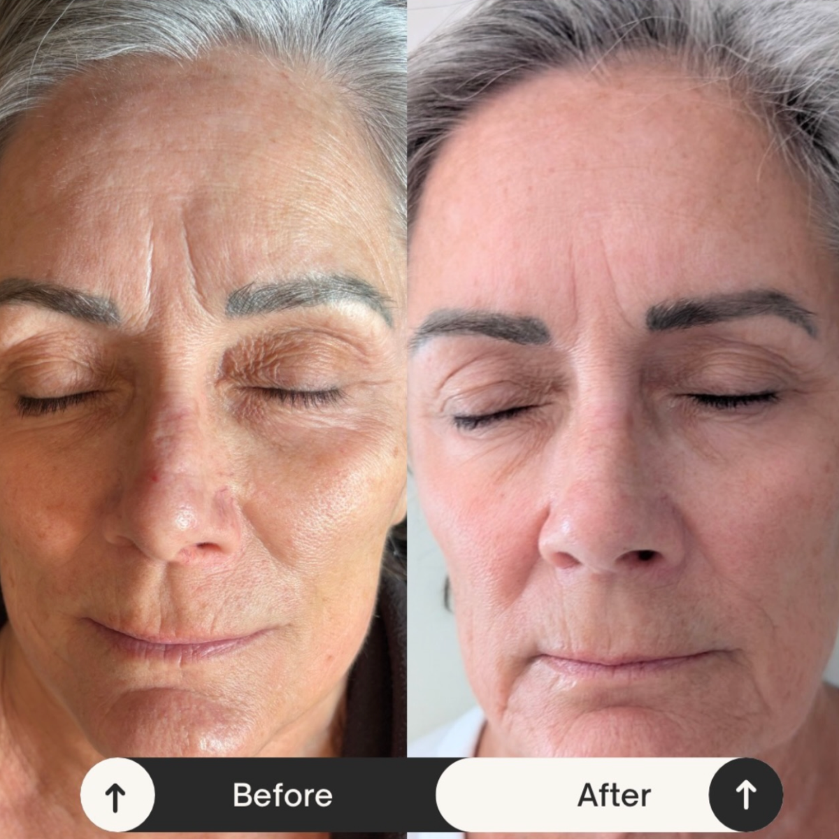 Before and after comparison of a woman's face with Alpha Glow Serum after a chemical peel. Gianna Velletta Pure Peel Chemical Peel Alpha Glow Serum A Peeling Beauty Before and After
